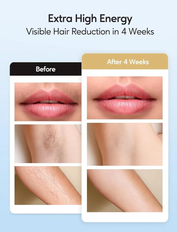 S721543df3955448bac3faf7e14ce71d4u.webp IPL Hair Removal with Ice Cooling Care Function for Women Permanent,999,999 Flashes Painless IPL Hair Remover Device